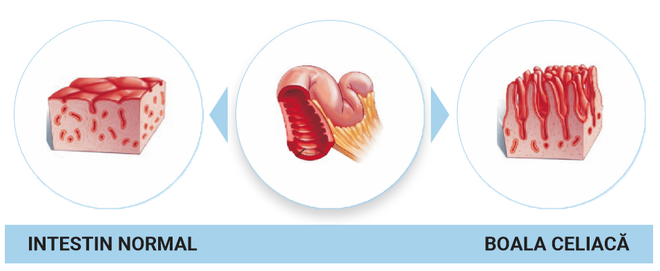 Intoleranța la gluten sau boala celiacă - Synevo